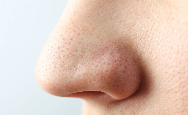 深層清潔毛孔，去除粉刺與黑頭，改善膚質粗糙