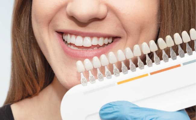 配戴張口器進行牙齒色階比對與美白效果預測