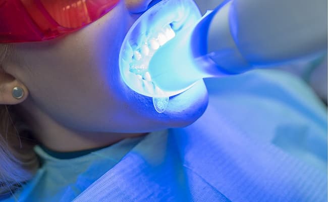 進行淨白牙齒療程，美齒SPA護理過程