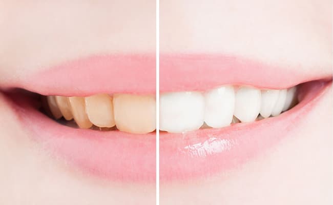 牙齒美白後色階比對，確認淨白效果